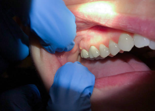 Best Emergency Dental Care for Broken or Chipped Teeth in Russell, KY